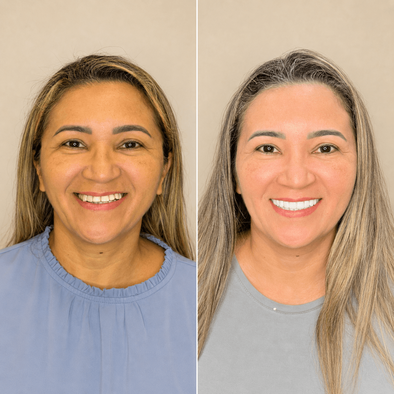 Antes e depois — Implante Zigomático