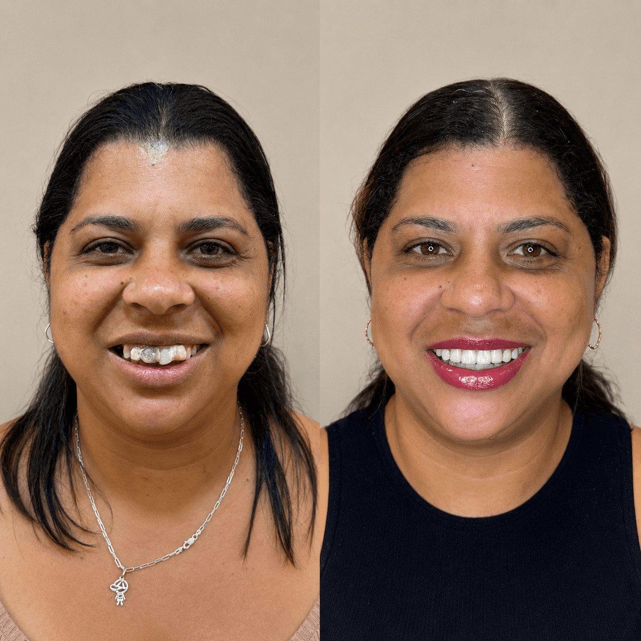 Antes e depois — All-on-4 Superior