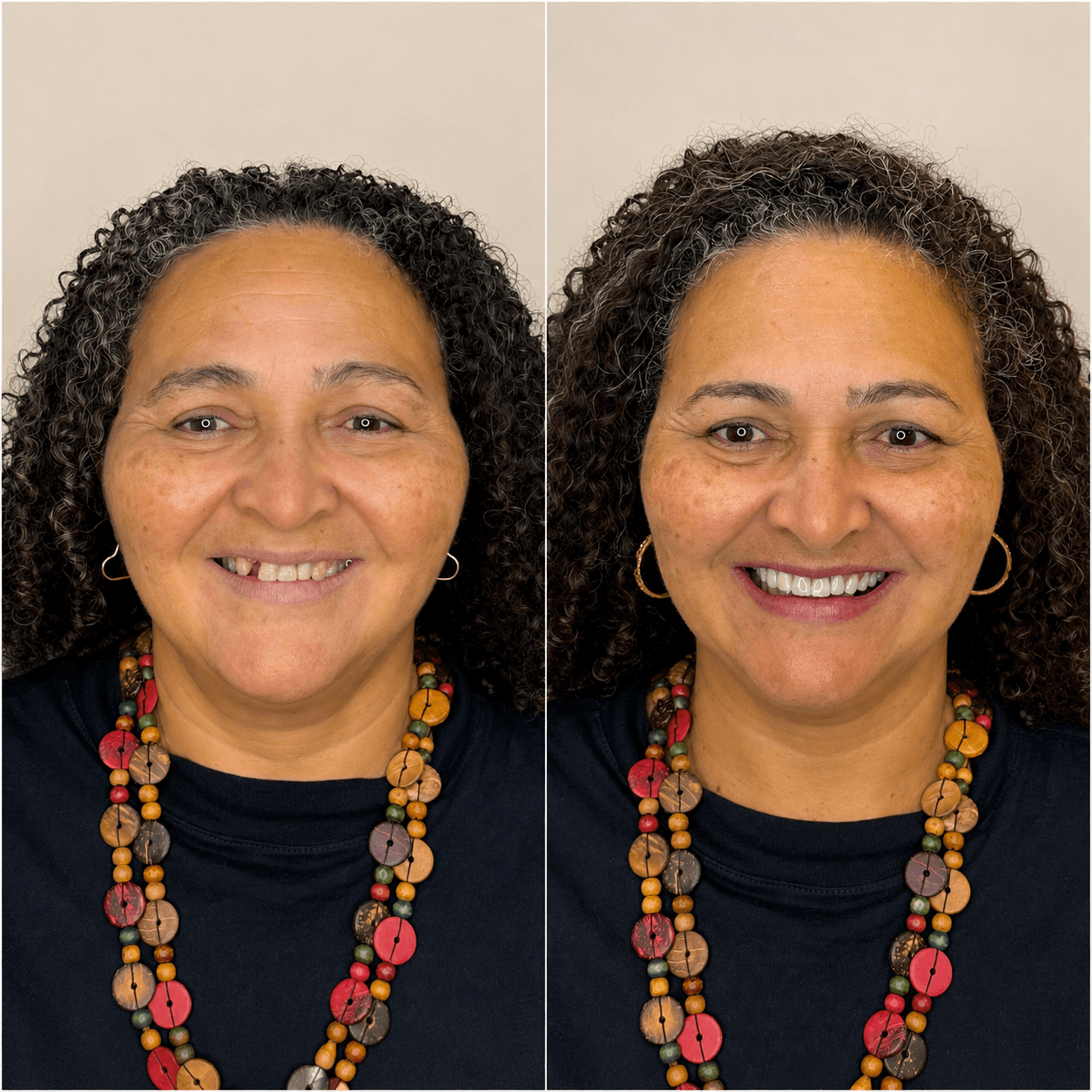 Antes e depois — Protocolo All-on-6