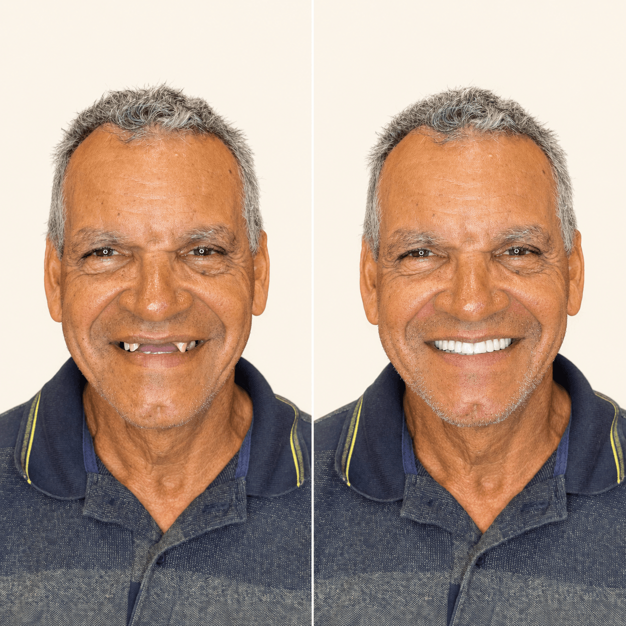 Antes e depois — Protocolo All-on-4
