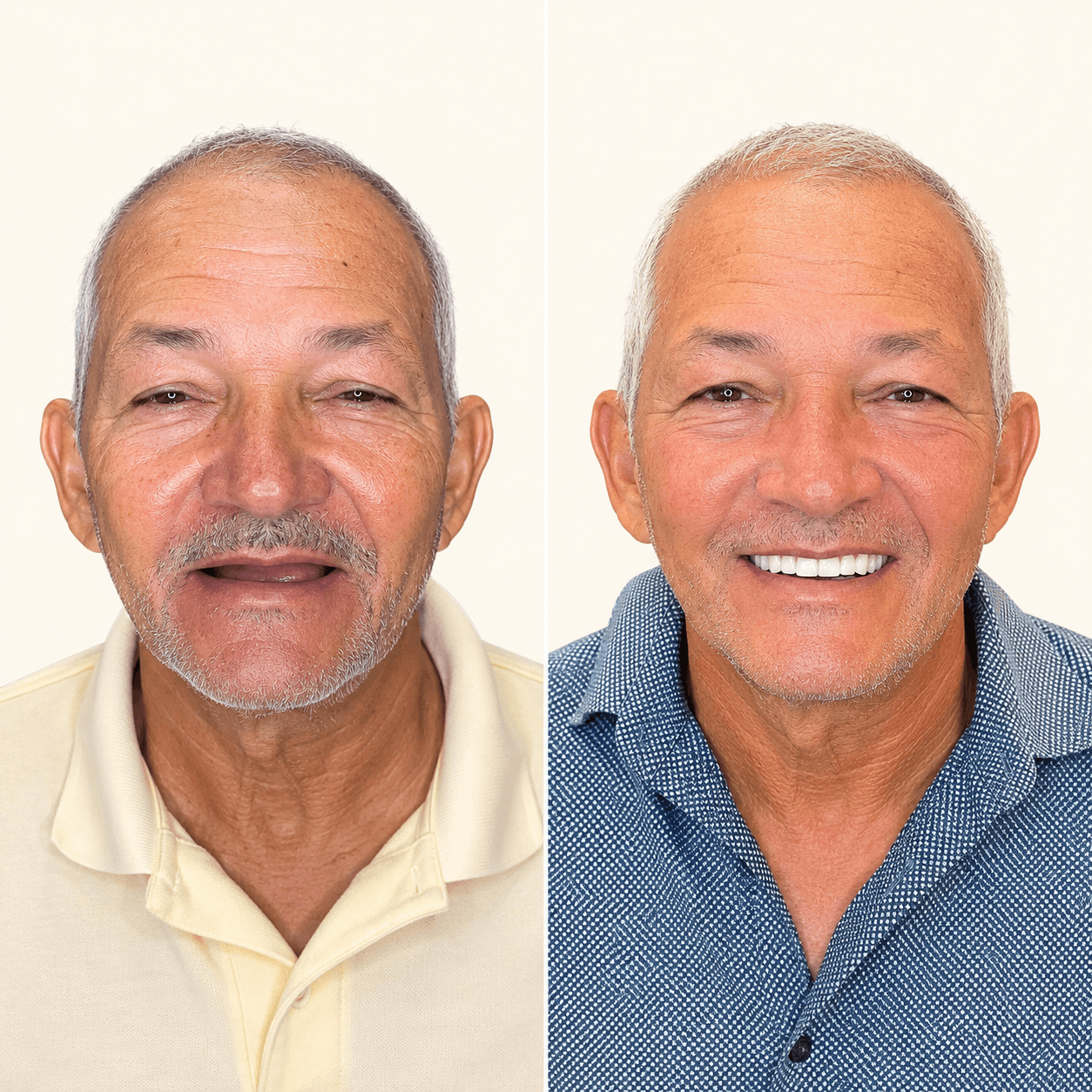 Antes e depois — Implante Zigomático