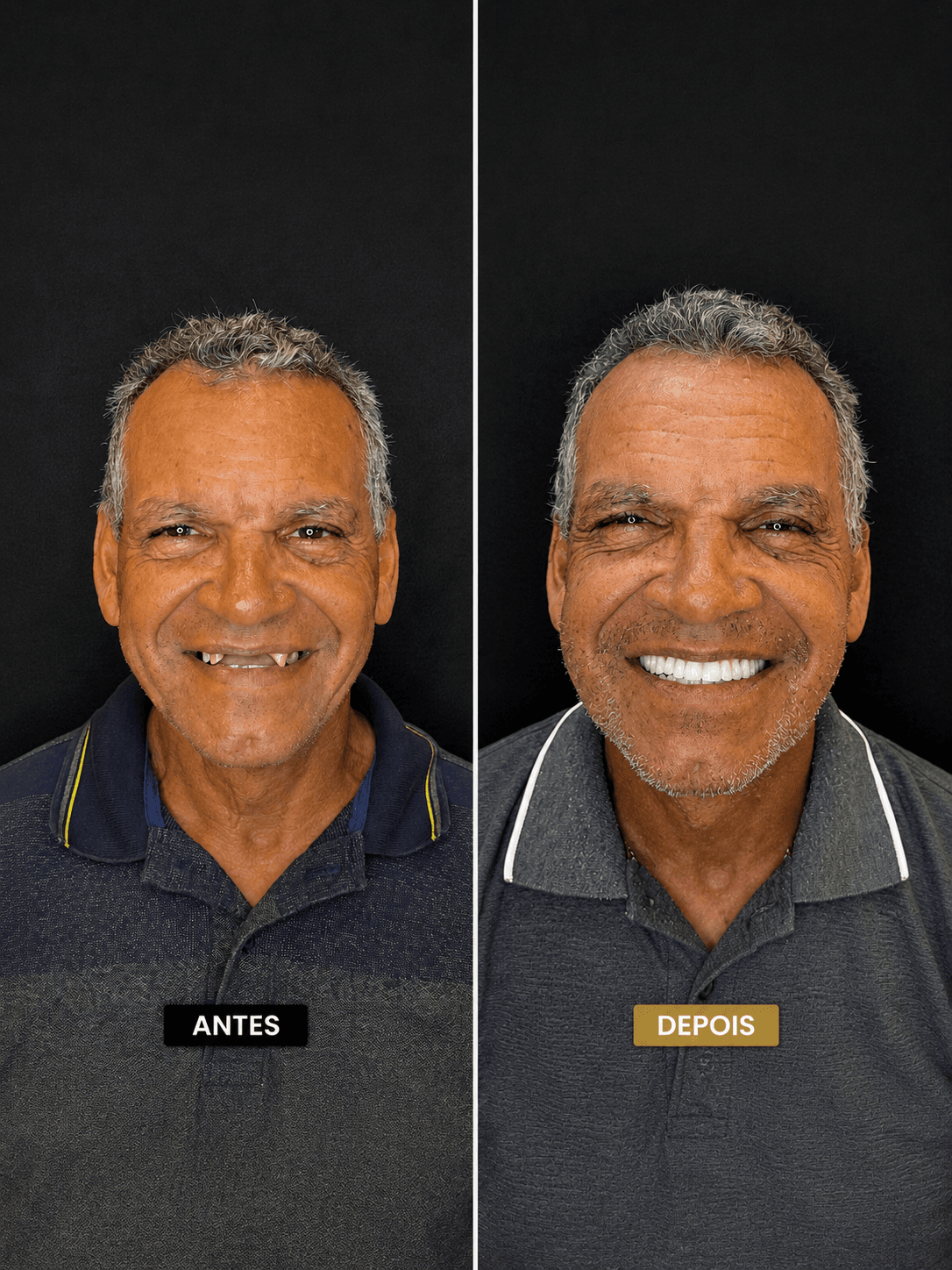 Implante dentário — Dr. Jones, Porto Velho